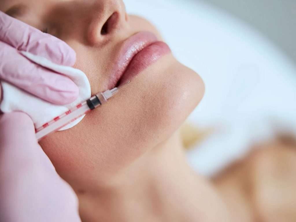subtle lip filler results natural lip enhancement treatment San Diego