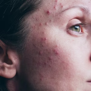Smoother and brighter skin after professional skin resurfacing treatment