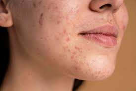 improving skin texture at Allurant Medical Spa in San Diego