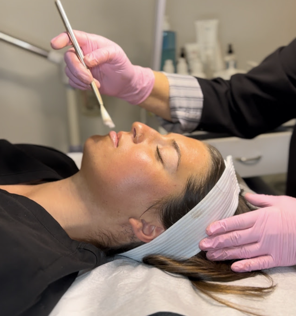 Professional chemical peel facial treatment for skin resurfacing in Carmel Valley San Diego