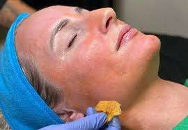 Patient receiving a chemical peel treatment at clinic in San Diego.