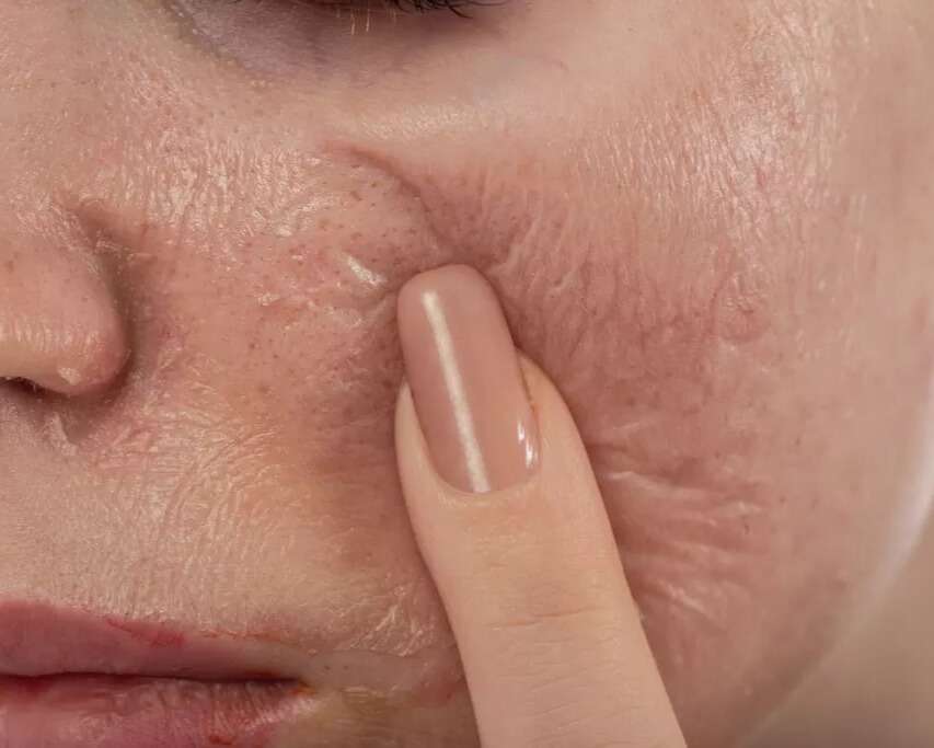Patient with chemical peel on in San Diego