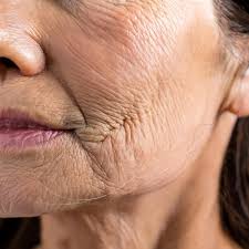 Patient showing fine line and wrinkles before chemical peel treatment in San Diego.