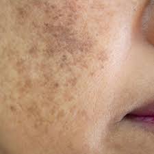 Patient with hyperpigmentation and sun damage before chemical treatmetn in San Diego.