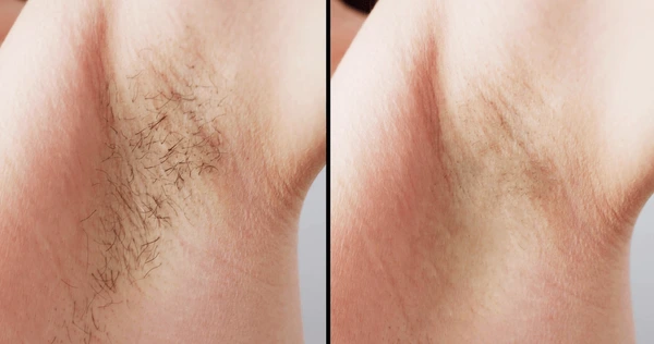 smooth skin treatment after laser hair reduction procedure