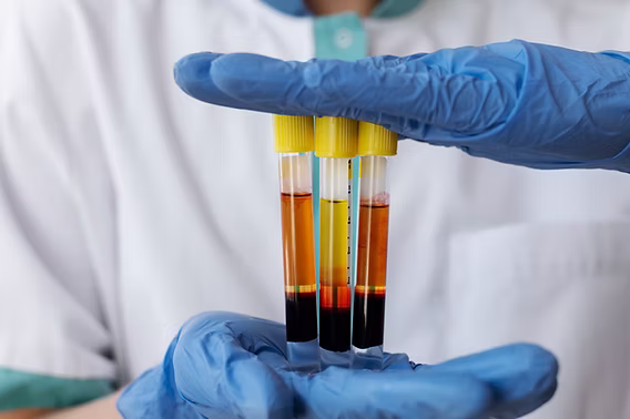Vial of PRF, platelet rich fibrin, prepared from a patient's own blood sample