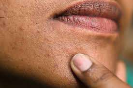 Professional exfoliation treatment for sun damage and dark spots