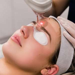 CO2 Laser Resurfacing