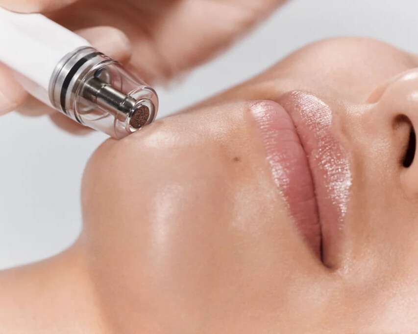 Diamond Glow facial treatment at Allurant Medical Spa in San Diego improving skin glow, hydration, and rejuvenation