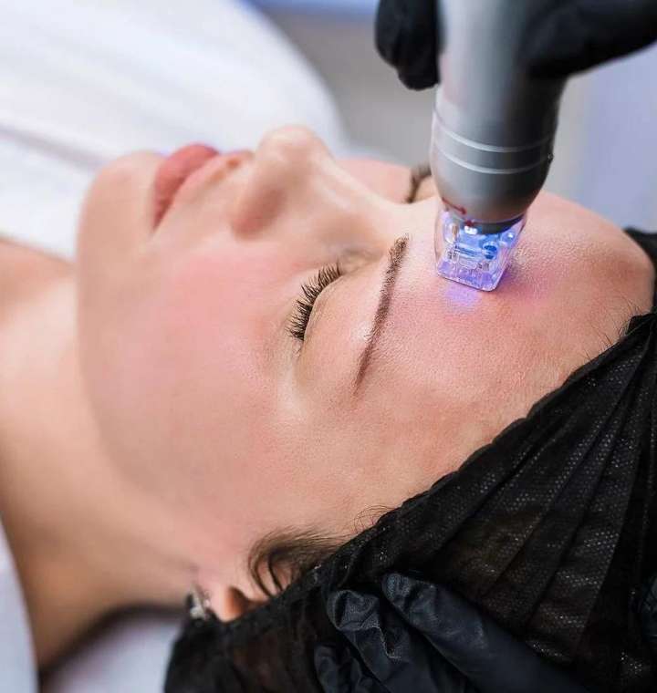 RF microneedling facial rejuvenation