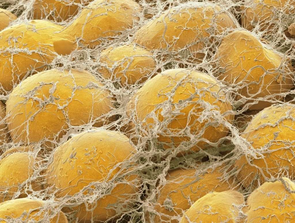 non invasive fat removal treatment
