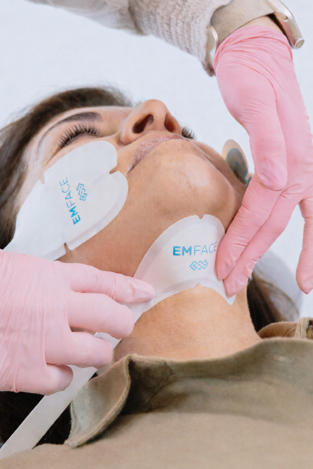 Smoother skin and improved facial definition after EMFACE treatments
