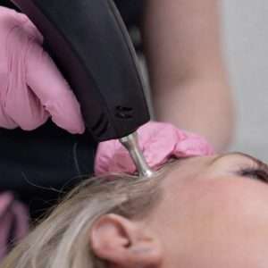 Advanced Non-Invasive Hair Restoration | 3 Sessions