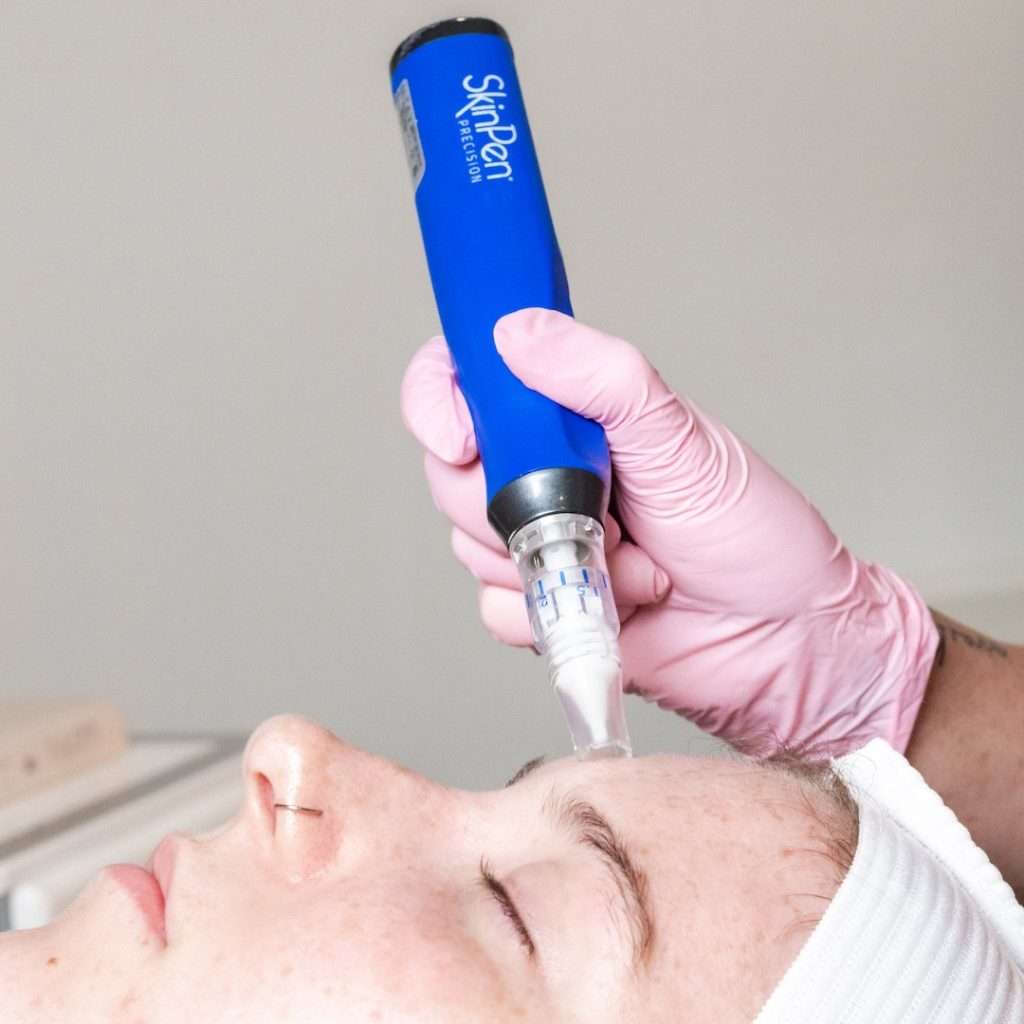 Close-up of microneedling procedure in San Diego with licensed practitioner at Allurant Medical Spa”
