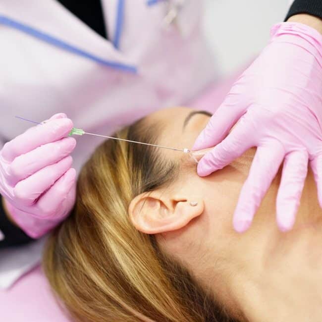 PDO thread lift treatment at Allurant Medical Spa providing non surgical facial lifting and rejuvenation