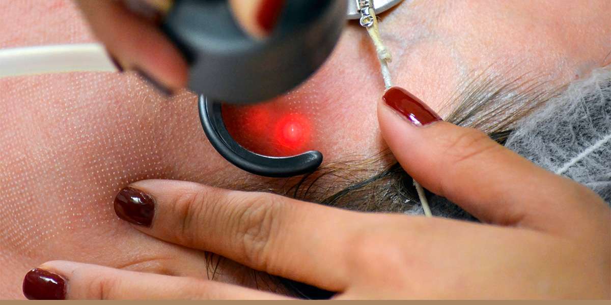 Pixel CO2 laser resurfacing treatment performed at Allurant Medical Spa in Carmel Valley San Diego