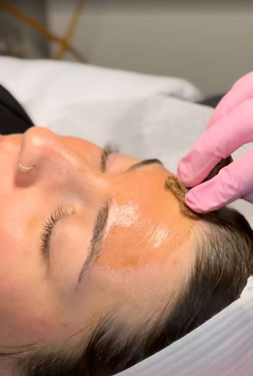 Advanced skin rejuvenation treatment at Allurant Medical