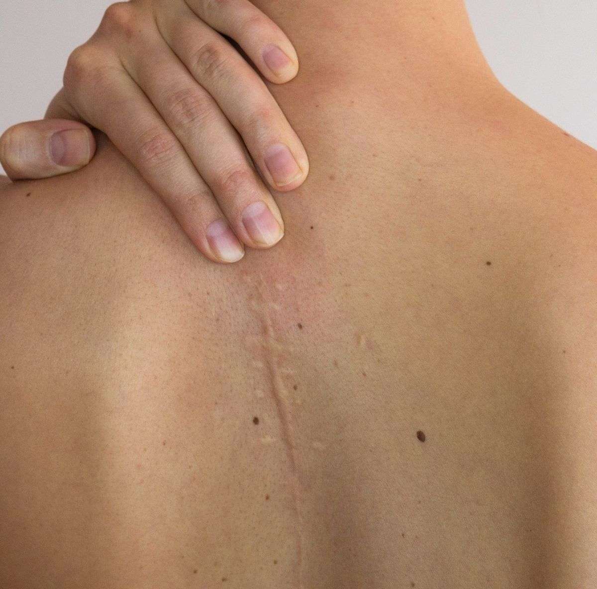 Medical spa treatment for body scars at Allurant Medical in San Diego