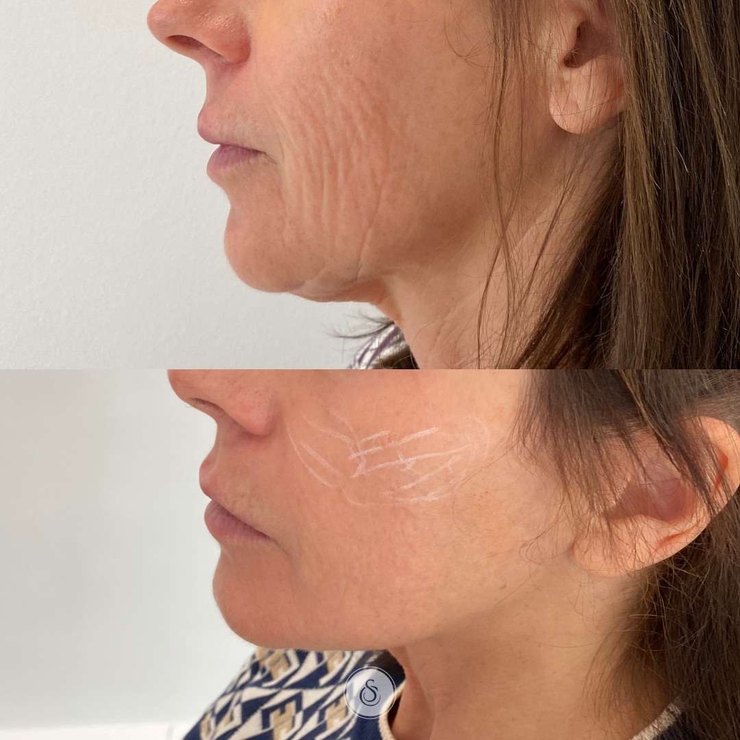 Radiesse filler before and after results at Allurant Medical Spa in San Diego
