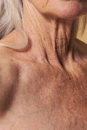 Non-surgical sagging skin treatment at Allurant Medical in San Diego