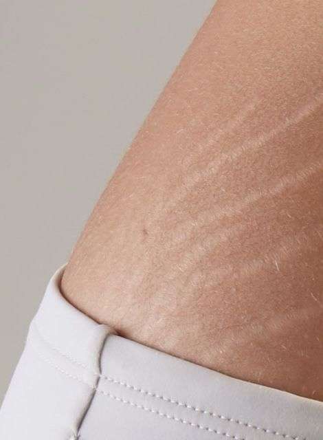 Medical spa treatment for stretch marks at Allurant Medical in San Diego
