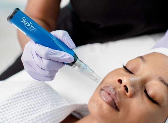 Microneedling treatment at Allurant Medical Spa in San Diego for skin rejuvenation and collagen boost