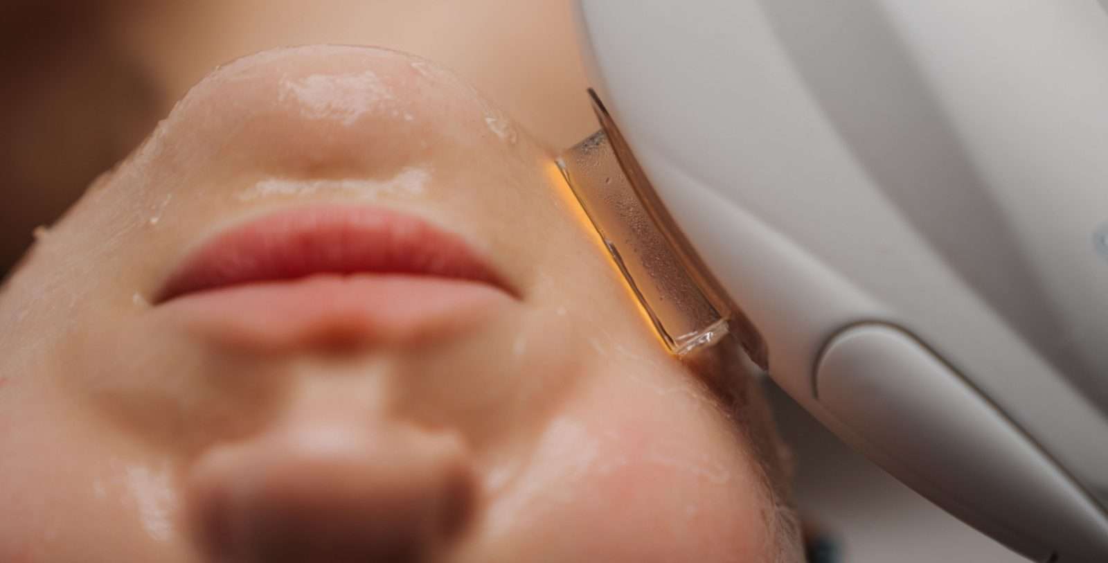 IPL laser treatment San Diego at Allurant Medical Spa