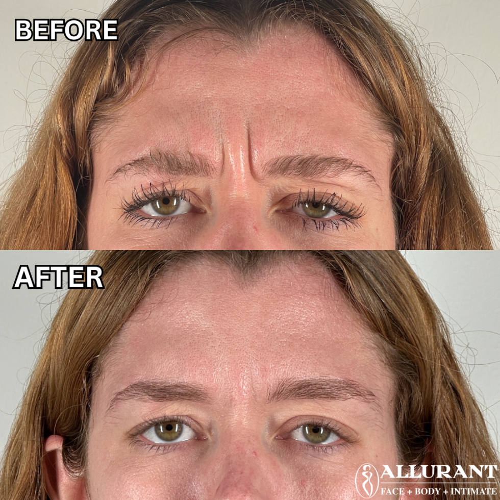 BOTOX ELEVEN LINES