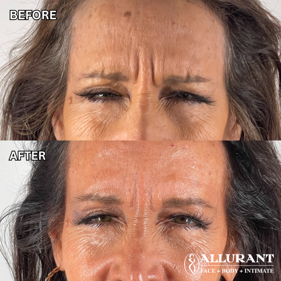 BOTOX TO ELEVEN LINES B&A