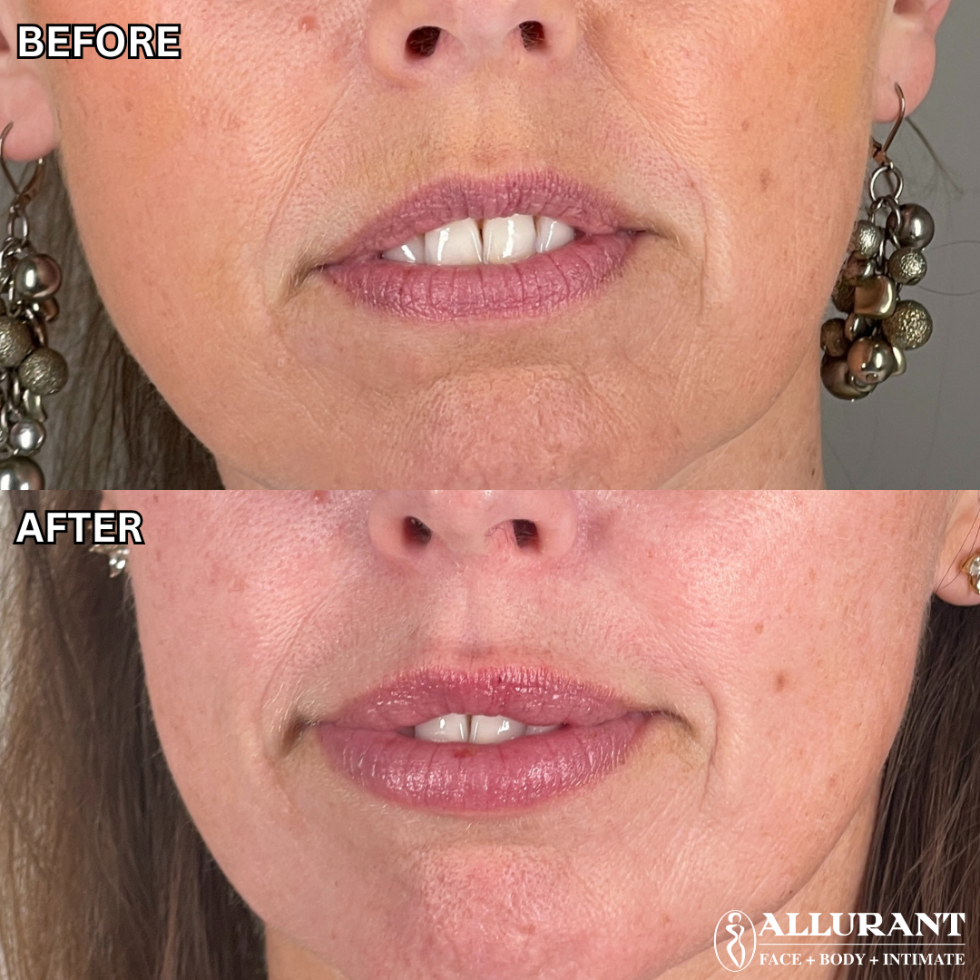 DERMAL FILLLER TO LIPS B&A