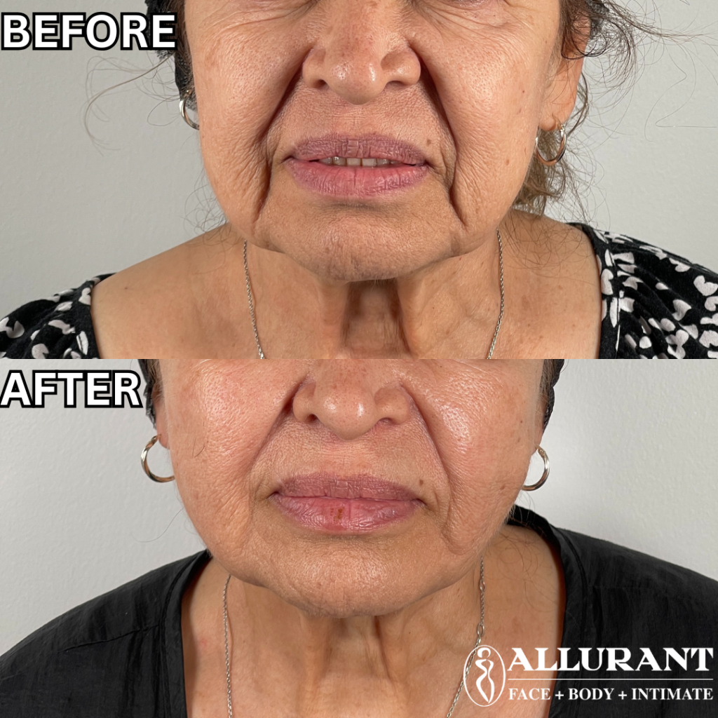 thread lift treatment improving jawline definition and reducing sagging jowls
