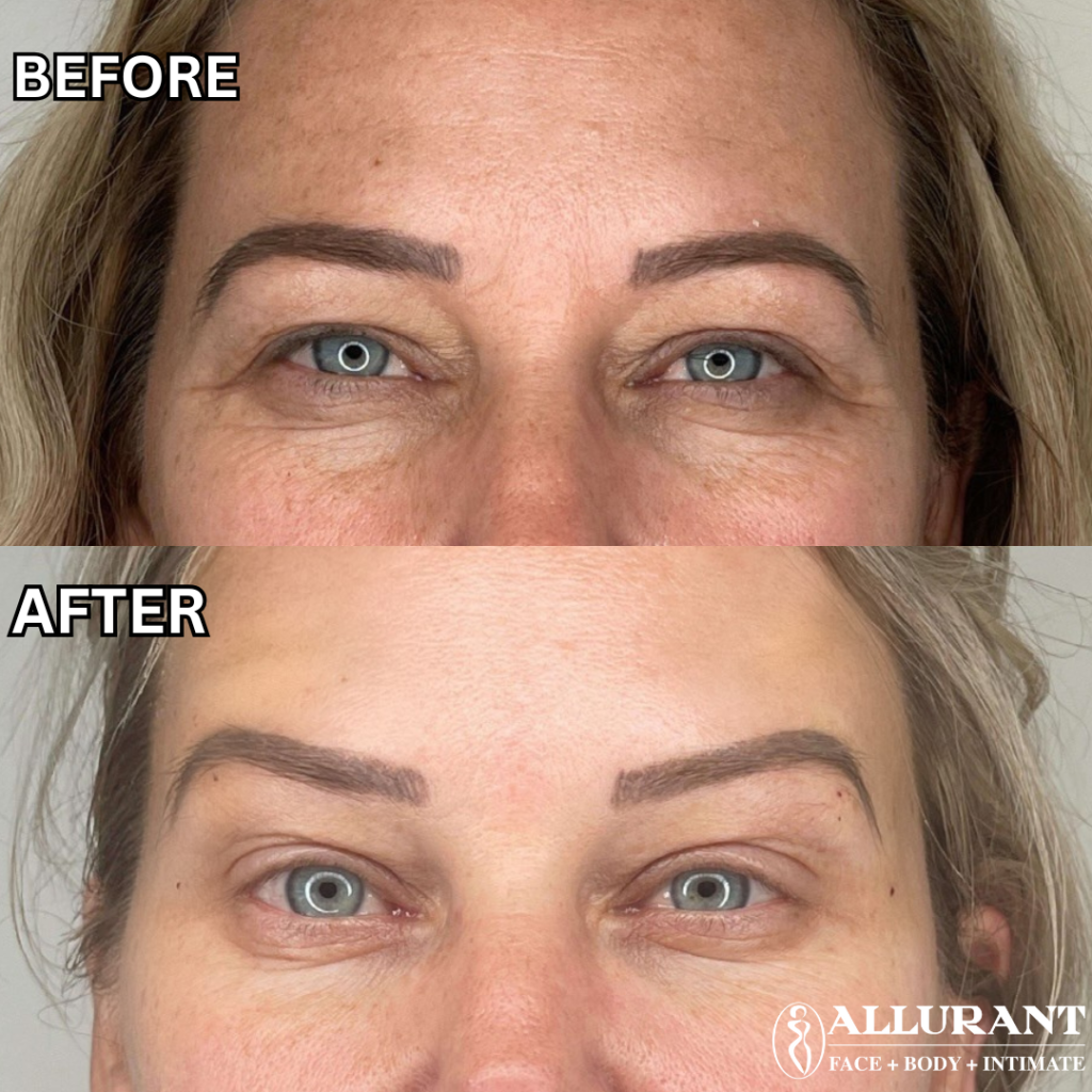 PDO thread lift brow treatment creating a subtle non surgical brow lift