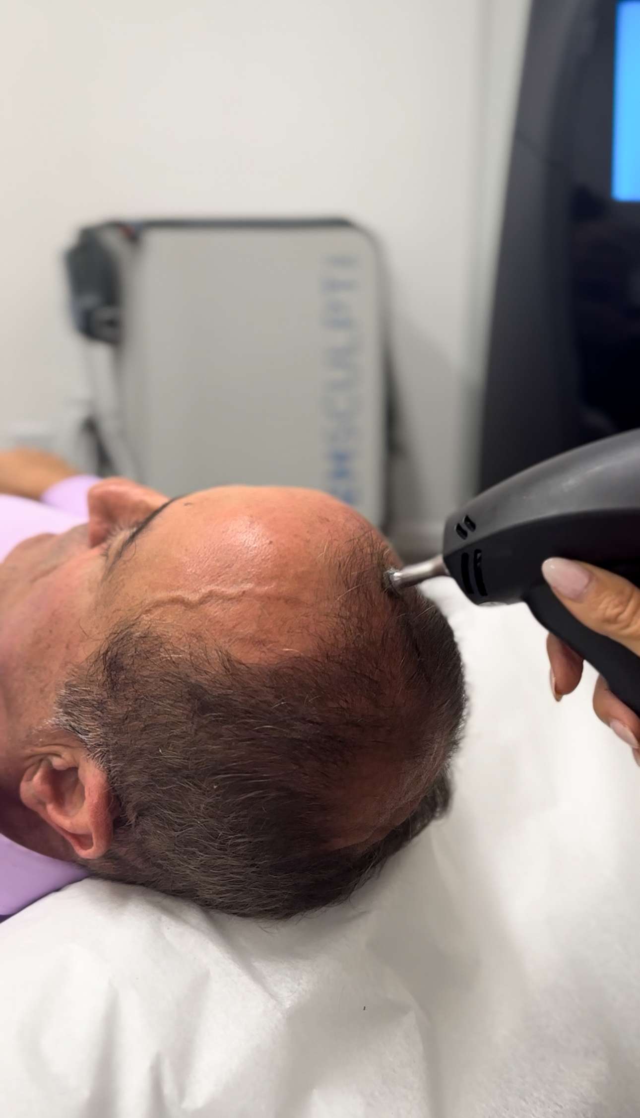 Non-surgical hair growth and scalp rejuvenation at Allurant Medical