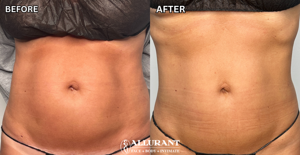 ACCELERATED MEDICAL WEIGHT LOSS B&A 1