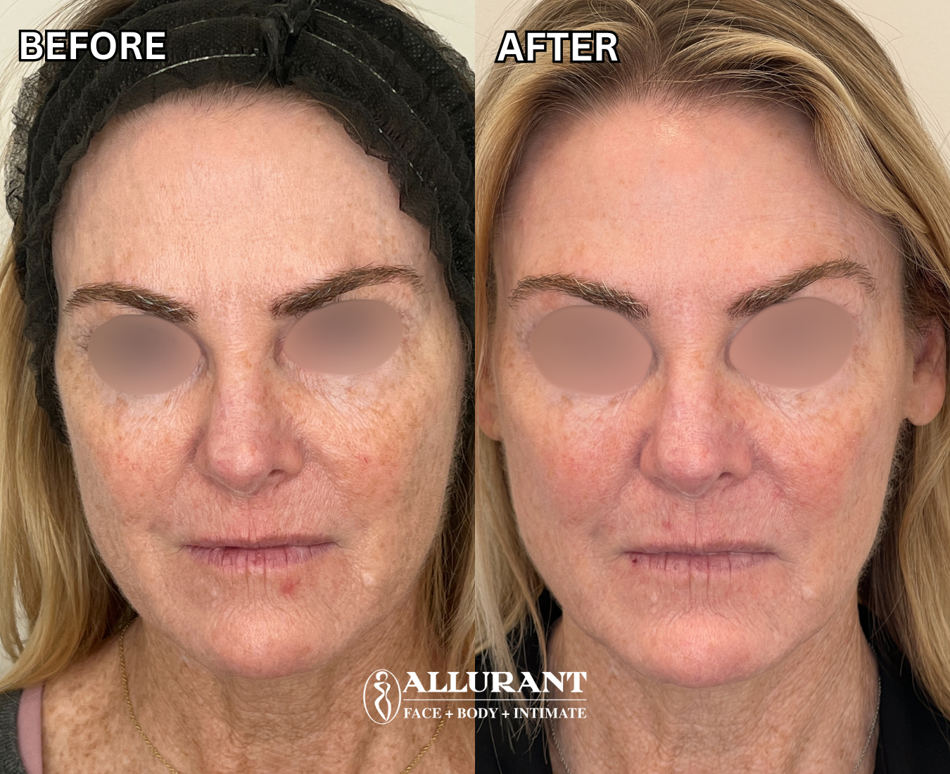 ADVATx laser treatment before and after results in San Diego