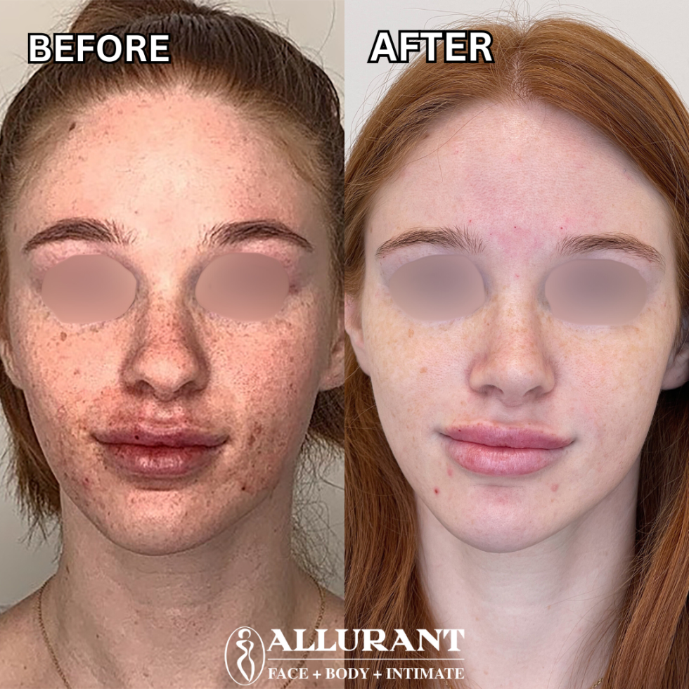 ADVA TX B&A (kelly white)