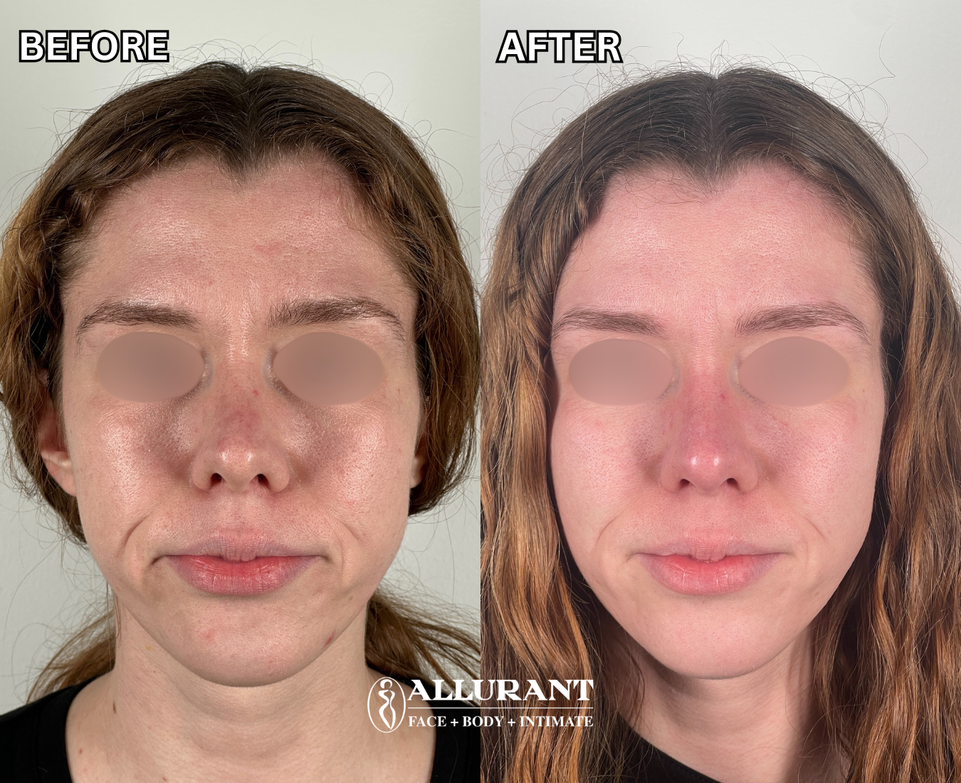 ADVATx laser skin tone improvement before and after San Diego