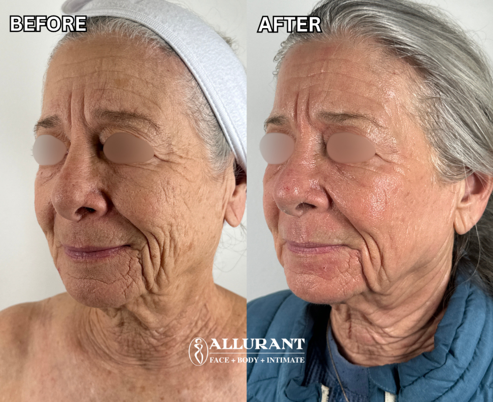 ANN GOLDSTEIN CO2 LASER RESURFACING B&A