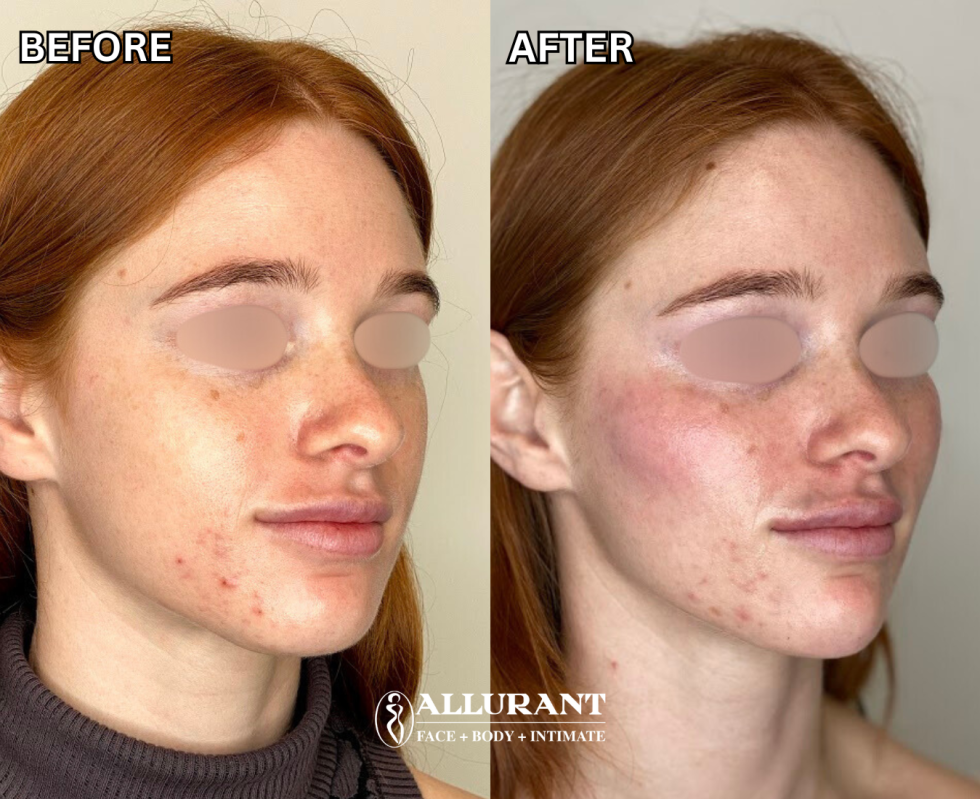 BIOSTIMULATOR (RADIESSE) TO CHEEKS B&A (kelly white)