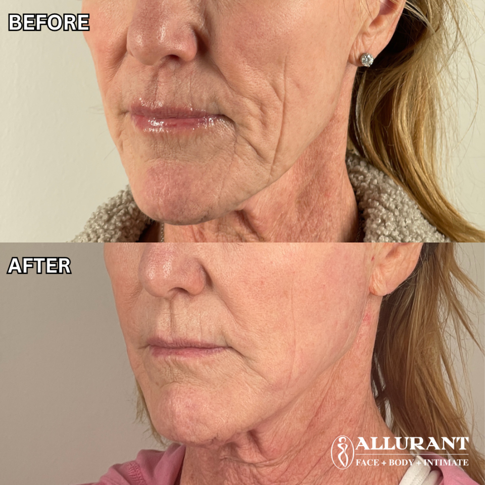 BIOSTIMULATOR RADIESSE TO LOWER FACE (CHIN + CHEEKS) B&A (colleen lambert)