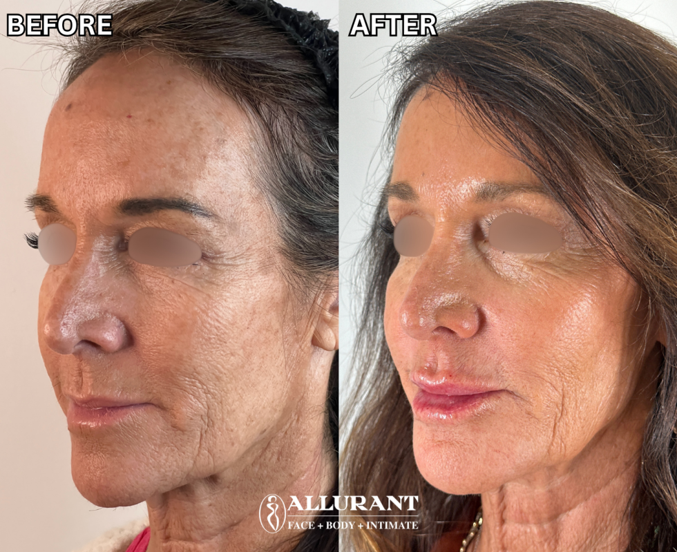 BIOSTIMULATOR SCULPTRA FACIAL RESHAPING B&A (1)