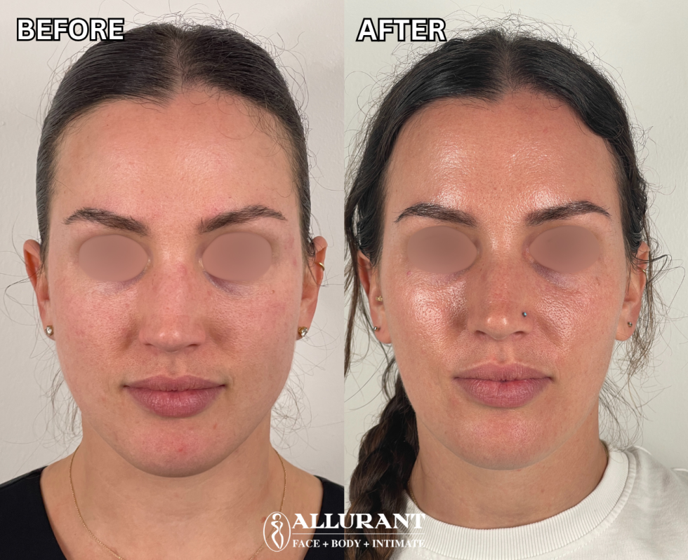 BIOSTIMULATOR-SCULPTRA-FACIAL-RESHAPING-BA-3