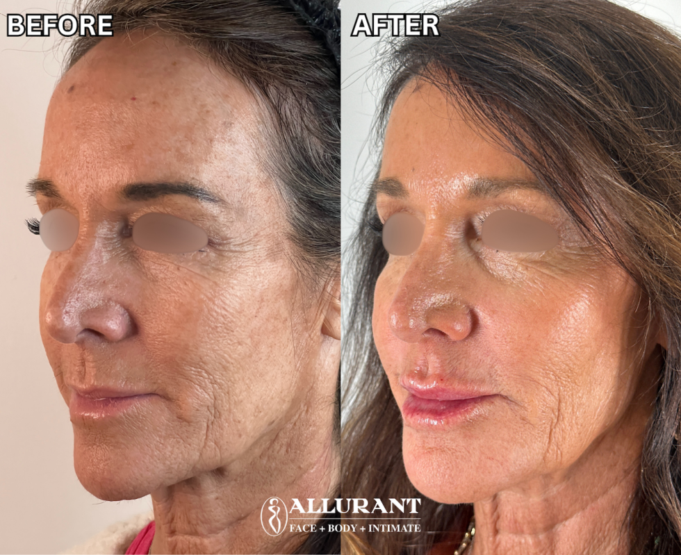 BIOSTIMULATOR SCULPTRA FACIAL RESHAPING B&A (kathy babcock)