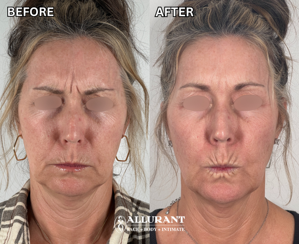 BOTOX ELEVEN LINES + NASOLABIAL LINES + LOWER FACE B&A(lianna lienau) Botox in San Diego before and after frown line treatment