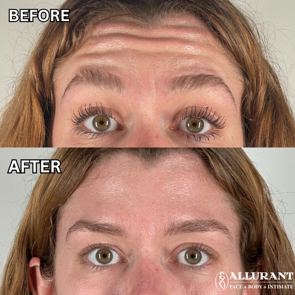 BOTOX, FOREHEAD LINES B&A Botox in San Diego before and after forehead lines treatment