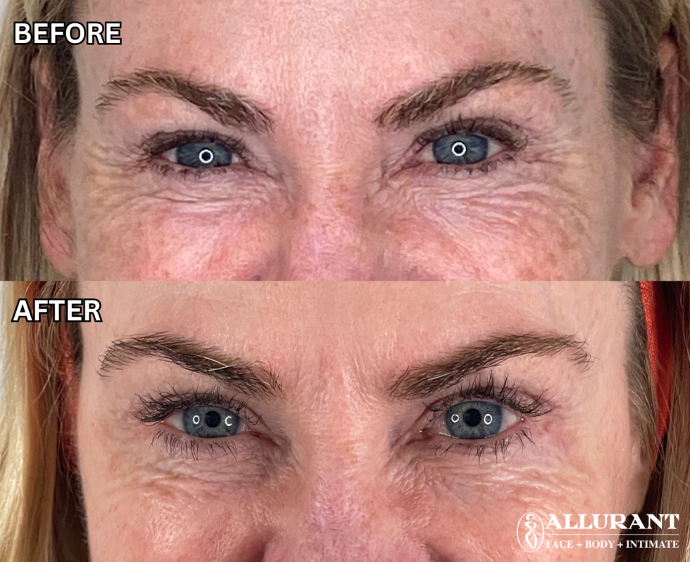 BOTOX TO CROWS FEET B&A (jean kerr) (1)