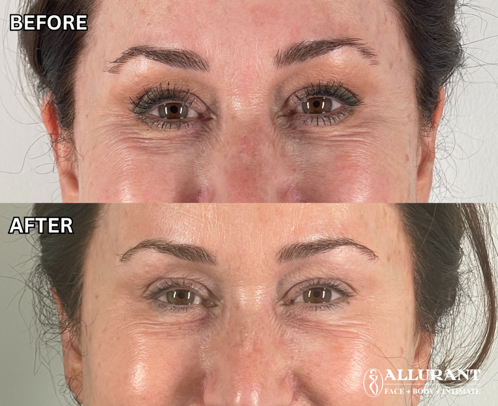 BOTOX TO CROWS FEET B&A (melissa fargo) (1)