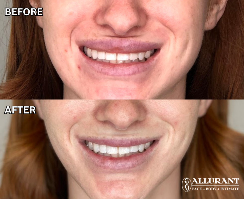 BOTOX TO UPPER HORIZONTAL LIP LINE B&A (kelly white) (1)