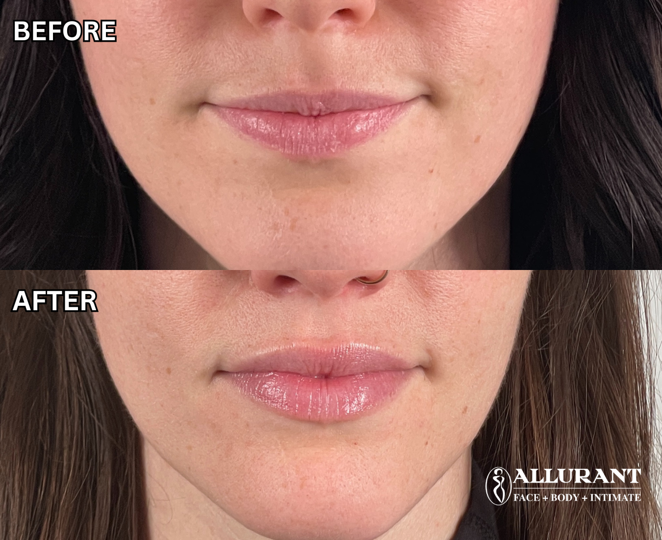 patient smiling after lip filler treatment in San Diego natural lip injections results