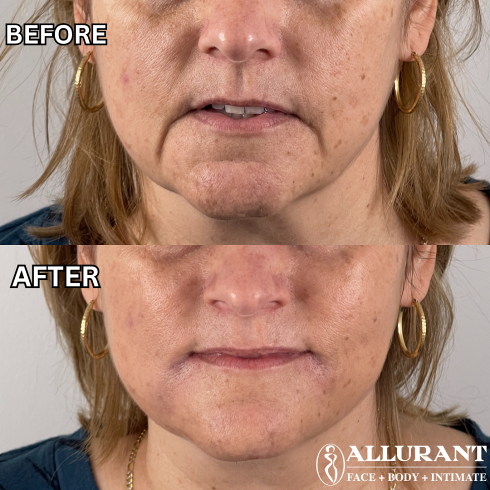 DERMAL FILLER, MARIONETTE LINES RESTYLANE B&A 1